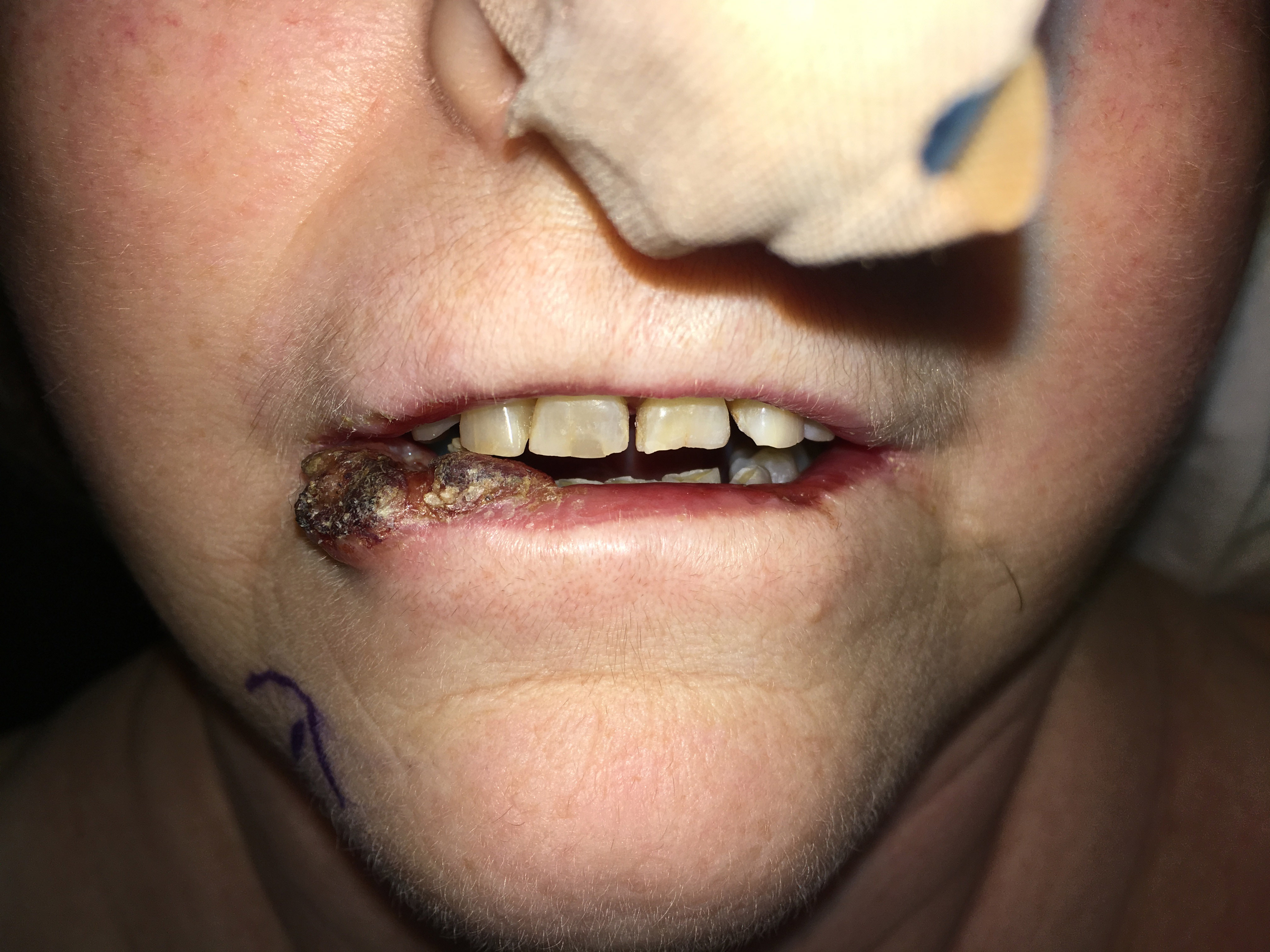 ulcerated lip