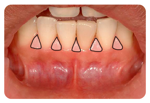 Lower Labial Sulcus