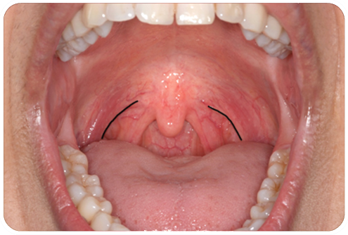 Soft Palate