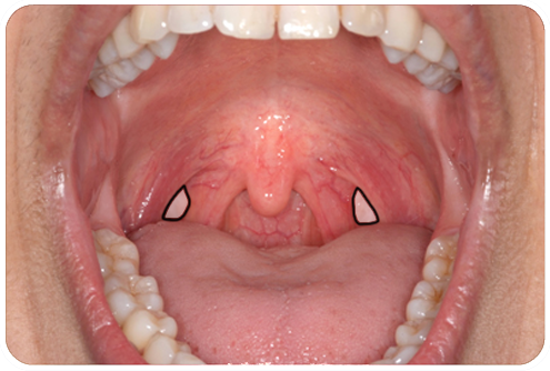 Soft Palate