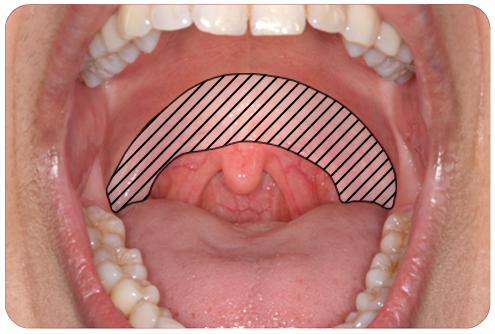 Soft Palate