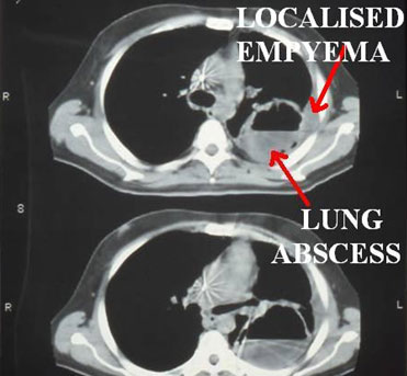 Chest CT scan