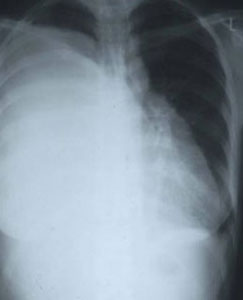 Pre-drainage Chest X-Ray