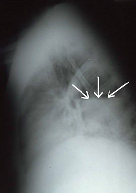 lateral chest X-Ray
