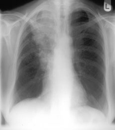 x-ray of patient presenting with empyema necessitans